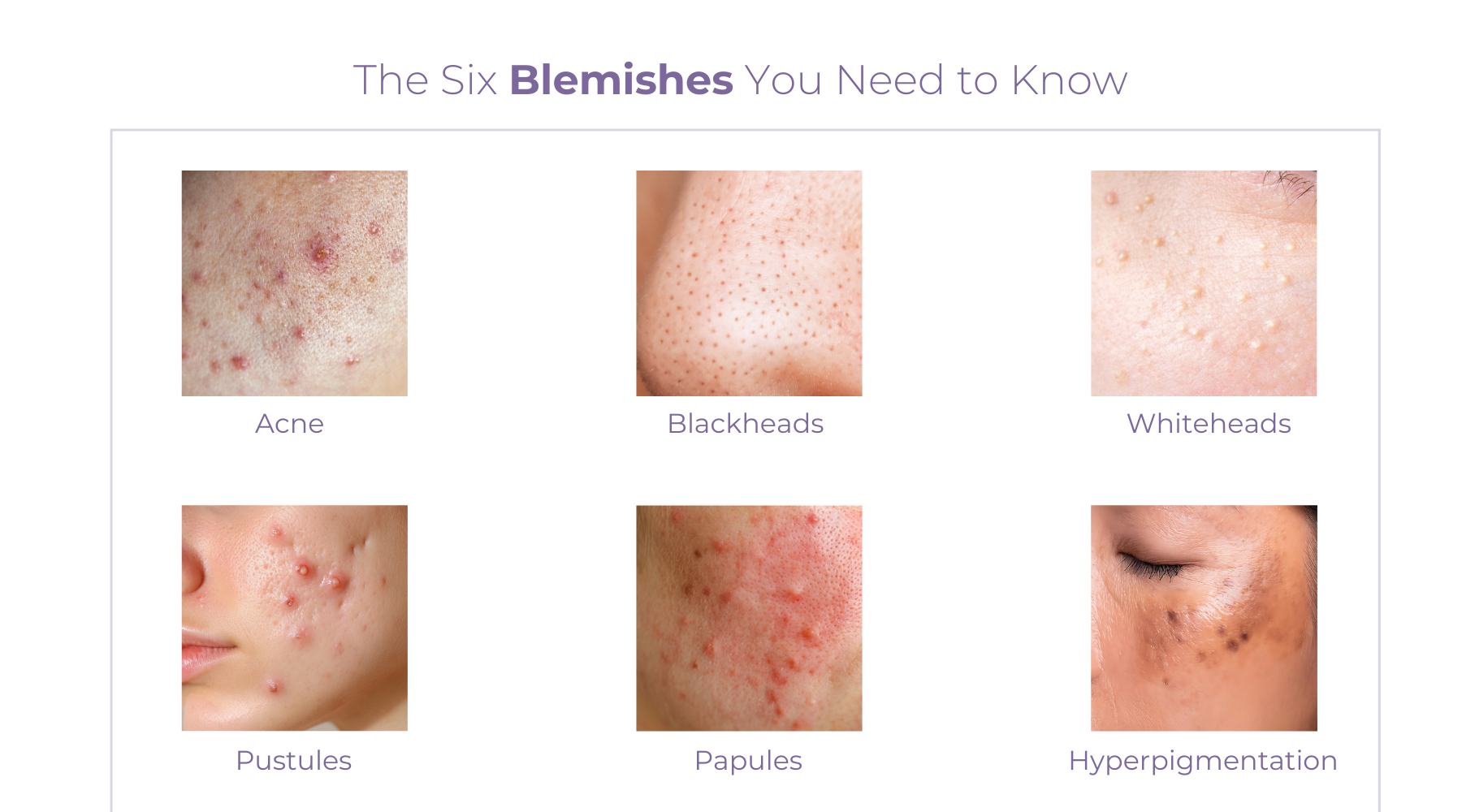 The Six Types of Skin Blemishes & What They Mean – Long Story