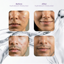 Hydrobloom Moisturizer before and after showing balanced, hydrated skin